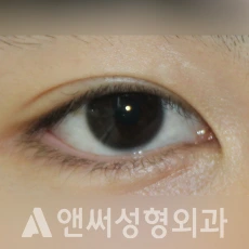 Answer Plastic Surgery case 256: Before