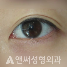 Answer Plastic Surgery case 255: Before