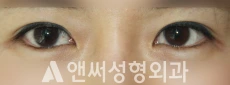 Answer Plastic Surgery case 253: Before