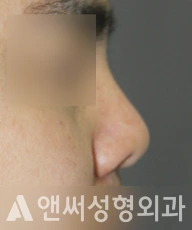 Answer Plastic Surgery case 252: Before