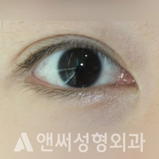 Answer Plastic Surgery case 246: Before
