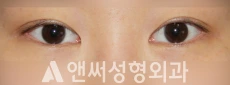 Answer Plastic Surgery case 245: Before