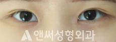 Answer Plastic Surgery case 244: Before