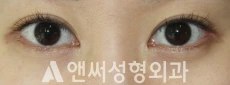 Answer Plastic Surgery case 243: Before