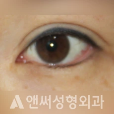 Answer Plastic Surgery case 240: Before