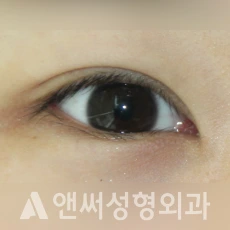 Answer Plastic Surgery case 238: Before