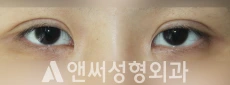Answer Plastic Surgery case 236: Before