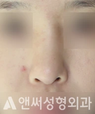 Answer Plastic Surgery case 233: Before