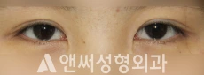 Answer Plastic Surgery case 230: Before