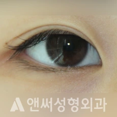 Answer Plastic Surgery case 229: Before