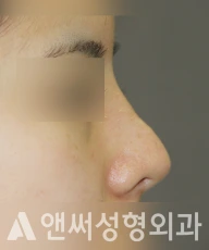 Answer Plastic Surgery case 228: Before