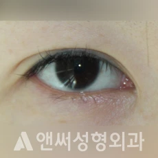 Answer Plastic Surgery case 227: Before