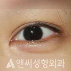 Answer Plastic Surgery case 226: Before