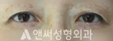 Answer Plastic Surgery case 225: Before