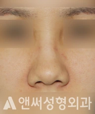 Answer Plastic Surgery case 223: Before