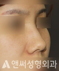 Answer Plastic Surgery case 222: Before