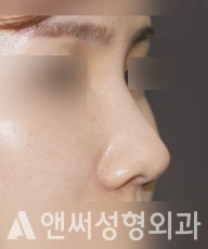 Answer Plastic Surgery case 222: After