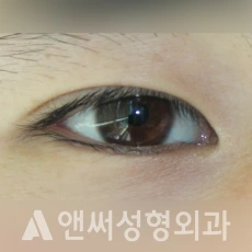 Answer Plastic Surgery case 221: Before