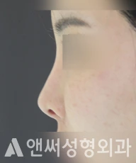 Answer Plastic Surgery case 220: Before