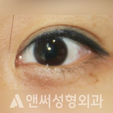 Answer Plastic Surgery case 219: Before