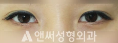 Answer Plastic Surgery case 218: Before