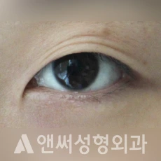 Answer Plastic Surgery case 217: Before