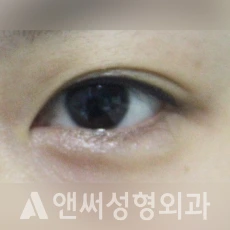 Answer Plastic Surgery case 215: Before