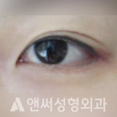Answer Plastic Surgery case 215: After