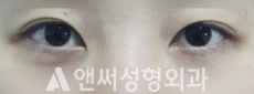 Answer Plastic Surgery case 211: Before