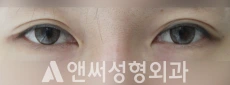 Answer Plastic Surgery case 209: Before