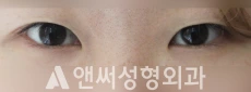 Answer Plastic Surgery case 206: Before