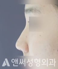Answer Plastic Surgery case 203: Before
