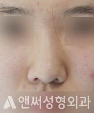 Answer Plastic Surgery case 201: Before