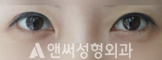Answer Plastic Surgery case 196: Before