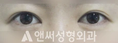 Answer Plastic Surgery case 144: Before