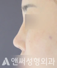 Answer Plastic Surgery case 143: Before