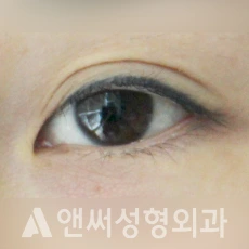 Answer Plastic Surgery case 142: Before