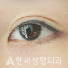 Answer Plastic Surgery case 142: After