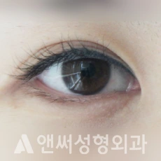 Answer Plastic Surgery case 140: Before