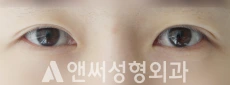 Answer Plastic Surgery case 139: Before