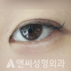 Answer Plastic Surgery case 134: Before