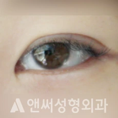 Answer Plastic Surgery case 134: After