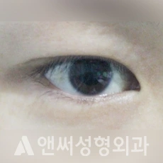 Answer Plastic Surgery case 132: Before