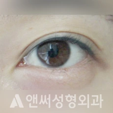 Answer Plastic Surgery case 131: Before