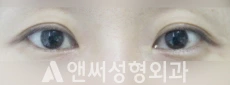 Answer Plastic Surgery case 130: Before