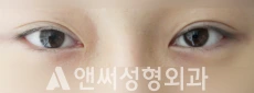 Answer Plastic Surgery case 128: Before