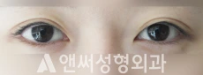 Answer Plastic Surgery case 125: Before