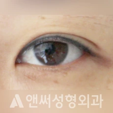 Answer Plastic Surgery case 124: Before
