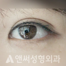 Answer Plastic Surgery case 124: After