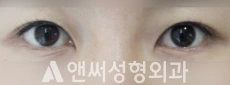 Answer Plastic Surgery case 121: Before